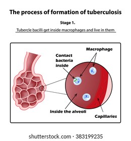 The development of tuberculosis. Stage 1. Infographics. Vector illustration on isolated background