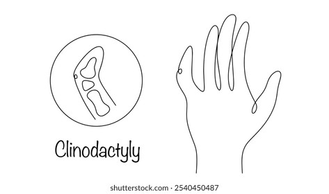 Una anomalía del desarrollo en la que los dedos están curvados o su posición relativa a la dirección axial de la extremidad se altera. Dibujado a mano con clinodactilia. Ilustración vectorial.