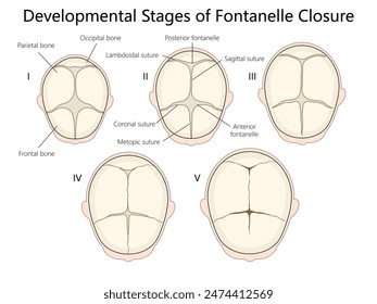 developmental stages of fontanelle closure in infants, detailing sutures and bone structure of the skull diagram hand drawn schematic vector illustration. Medical science educational illustration