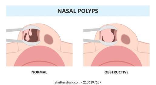 Deviated Ear ENT CPAP nose stop apnea block laser nasal RAVOR RFVTR runny sinus sleep treat airway concha device mucous polyps septal septum throat tissue airflow air way bullosa drip allergic