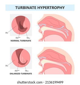 Deviated Ear ENT CPAP Nose Stop Apnea Block Laser Nasal RAVOR RFVTR Runny Sinus Sleep Treat Airway Concha Device Mucous Polyps Septal Septum Throat Tissue Airflow Air Way Bullosa Drip Allergic