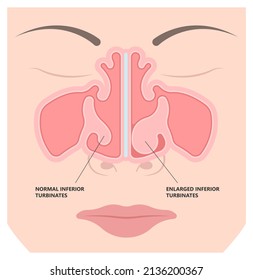 Deviated Ear ENT CPAP Nose Stop Apnea Block Laser Nasal RAVOR RFVTR Runny Sinus Sleep Treat Airway Concha Device Mucous Polyps Septal Septum Throat Tissue Airflow Air Way Bullosa Drip Allergic