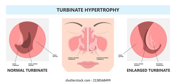 Deviated Ear ENT CPAP nose stop apnea block laser nasal RAVOR RFVTR runny sinus sleep treat airway concha device mucous polyps septal septum throat tissue airflow air way bullosa drip allergic