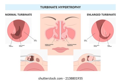 Deviated Ear ENT CPAP nose stop apnea block laser nasal RAVOR RFVTR runny sinus sleep treat airway concha device mucous polyps septal septum throat tissue airflow air way bullosa drip allergic