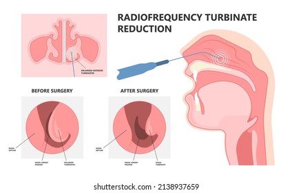 Antes y después del tratamiento para la rinitis alérgica y la obstrucción nasal