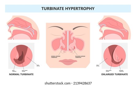 Deviated Ear ENT CPAP nose stop apnea block laser nasal RAVOR RFVTR runny sinus sleep treat airway concha device mucous polyps septal septum throat tissue airflow air way bullosa drip allergic