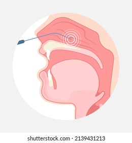 Deviated Ear ENT CPAP nose stop apnea block laser nasal RAVOR RFVTR runny sinus sleep treat airway concha device mucous polyps septal septum throat tissue airflow air way bullosa drip allergic