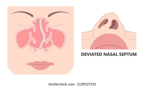 Deviated Ear ENT CPAP nose stop apnea block laser nasal RAVOR RFVTR runny sinus sleep treat airway concha device mucous polyps septal septum throat tissue airflow air way bullosa drip allergic