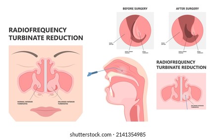 Deviated Ear ENT CPAP nose stop apnea block laser nasal RAVOR RFVTR runny sinus sleep treat airway concha device mucous polyps septal septum throat tissue airflow air way bullosa drip allergic