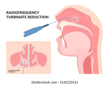 Deviated Ear ENT CPAP nose stop apnea block laser nasal RAVOR RFVTR runny sinus sleep treat airway concha device mucous polyps septal septum throat tissue airflow air way bullosa drip allergic