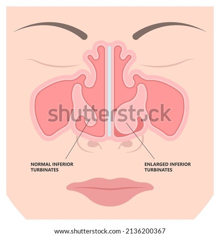Deviated Ear ENT CPAP nose stop apnea block laser nasal RAVOR RFVTR runny sinus sleep treat airway concha device mucous polyps septal septum throat tissue airflow air way bullosa drip allergic