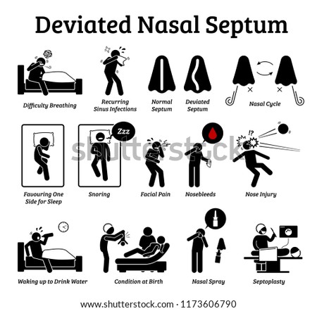 Deviated nasal septum icons. Illustrations depict signs and symptoms of nose problem. Difficulty breathing, sinus infection, snoring, and facial pain. Treatments are nasal spray and septoplasty.