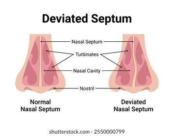 Deviated Nasal Septum Medical Vector Illustration