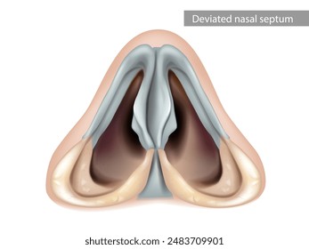 Tabique Nasal Desviado. Nariz, cavidad nasal. Vista inferior