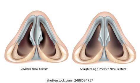 Deviated nasal septum and Straightening a Deviated Nasal Septum.  Septoplasty and Rhinoplasty