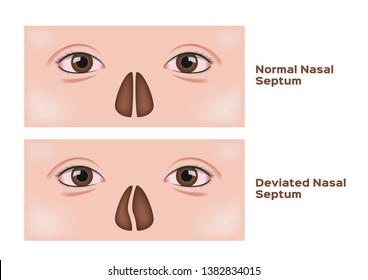 Deviated Nasal Septum Vector / Human Nose