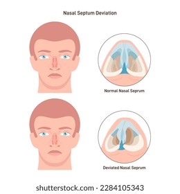 Deviated and normal nasal septum. Medical condition of crooked nasal septum. Bone and cartilage of human nasal cavity. Respiratory system problem. Flat vector illustration