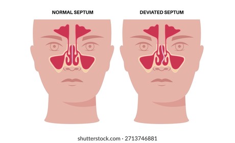 Cartaz de septo e obstrução nasal desviados. Problemas respiratórios, congestão e ronco. Sinusite e bloqueio do fluxo de ar no nariz humano. Ilustração médica vetorial da cartilagem e desvio ósseo