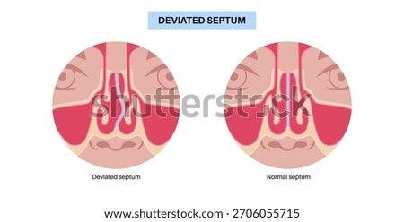 Deviated septum and nasal obstruction poster. Breathing problems, congestion and snoring. Sinusitis and airflow blockage in the human nose. Medical vector illustration of cartilage and bone deviation