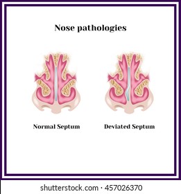 Gekochtes Septum. Nasenpathologie.