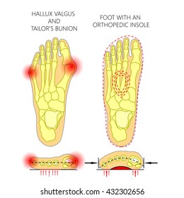 Deviation of the first and the fifth metatarsals transverse flatfoot with orthopedic insole. Used: gradient, transparency, blend mode.