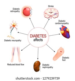 Diabetes Affects. Complications of diabetes mellitus: nephropathy, Diabetic foot, neuropathy, retinopathy, stroke; Reduced blood flow and cardiomyopathy. Vector diagram for educational, medical use