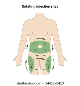 Printable Insulin Injection Site Chart