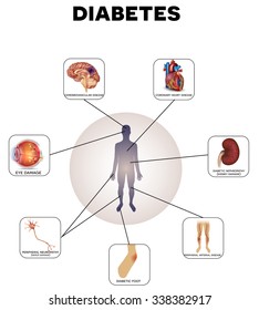 Diabetes complications detailed info graphic on a white background