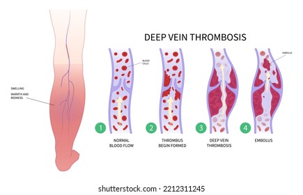 Diabetes Foot Chronic Leg Pain Varicose Stock Vector (royalty Free 