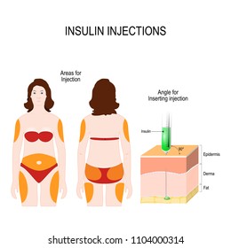 Diabetes mellitus. Angle for Inserting injection and Areas for insulin Injection. vector illustration for medical use