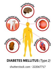 Diabetes Mellitus Type 2. Long-term Complications Include Heart Disease And Cardiomyopathy, Stroke And Encephalopathy, Kidney Failure, Periodontal Disease, Retinopathy And Other Damage To The Eyes.