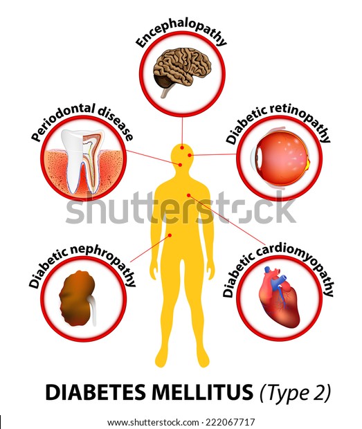 enfermedad renal en diabetes tipo 2