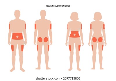 Diabetes treatment. Insulin injection sites on the human male and female bodies. Upper outer arms, abdomen, buttocks, upper outer thighs. Anatomical medical poster flat vector illustration for clinic.