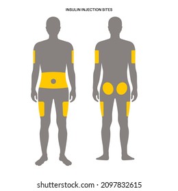 Diabetes treatment. Insulin injection sites on the human adult male body. Upper outer arms, abdomen, buttocks, upper outer thighs. Anatomical medical poster flat vector illustration for clinic