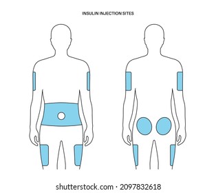 Behandlung von Diabetes. Insulinininjektionsstellen am männlichen menschlichen Körper. Obere Außenarme, Bauch, Gesäß, Oberschenkel. Anatomisches medizinisches Poster, flache Vektorgrafik für die Klinik