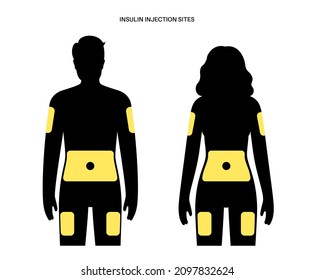 Diabetes treatment. Insulin injection sites on the human male and female bodies. Upper outer arms, abdomen, buttocks, upper outer thighs. Anatomical medical poster flat vector illustration for clinic.