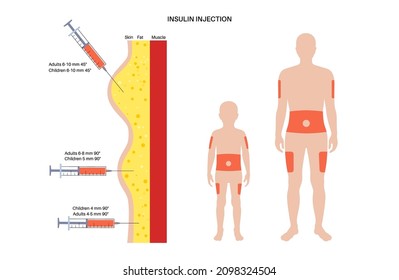 Diabetes treatment. Insulin injection sites on the human adult and child bodies. Upper outer arms, abdomen, buttocks, upper outer thighs. Anatomical medical poster flat vector illustration for clinic