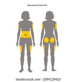 Tratamiento de la diabetes. Lugares de inyección de insulina en el cuerpo femenino humano adulto. Brazos exteriores superiores, abdomen, nalgas, muslos exteriores superiores. Afiche médico anatómico gráfico vectorial plano para clínica