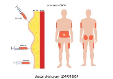 Behandlung von Diabetes. Insulinininjektionsstellen am männlichen menschlichen Körper. Obere Außenarme, Bauch, Gesäß, Oberschenkel. Anatomisches medizinisches Poster, flache Vektorgrafik für die Klinik