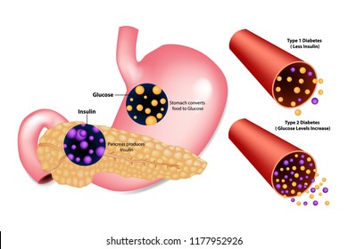 Diabetes Type 1( Less Insulin) And Type 2 (Glucose Levels Increase). Stomach Converts Food To Glucose. Pancreas Produces Insulin.