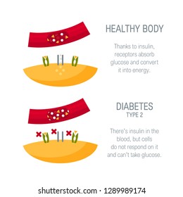 Diabetes Type 2 Concept. Diagram For Medical Infographic. Vector Illustration In Flat Style