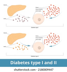 Diabetes tipo I y II.	Visualización esquemática de dos tipos de diabetes: tipo uno (el páncreas no produce insulina) y tipo dos (las células no pueden usarla).