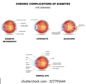 Diabetic Eye Diseases. Retinopathy, cataract and glaucoma detailed structure.