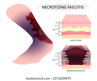 Diabetic foot and Bacteria infection on the skin cancer with Necrotizing fasciitis of leg cause limb pain fat scab in medical care