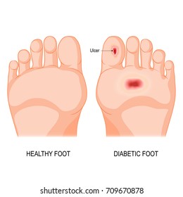 diabetic foot. Foot bottom pathology. Male or female sole. barefoot.