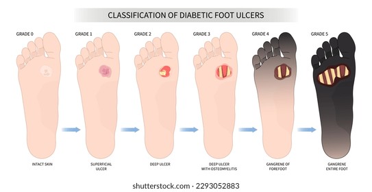 Heridas en los pies con bacterias infectadas que causan úlceras de diverso tipo en la medicina