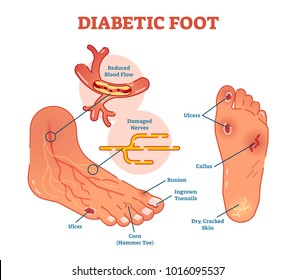 Diabetic foot medical vector illustration scheme with common foot conditions.