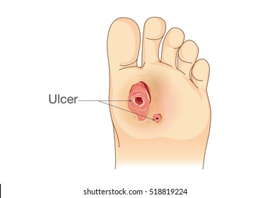 Diabetic Foot Pain and Ulcers. Skin Sores on Foot. Illustration about Diabetes Symptoms.