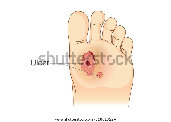 Diabetic Foot Pain and Ulcers. Skin\
Sores on Foot. Illustration about Diabetes\
Symptoms.