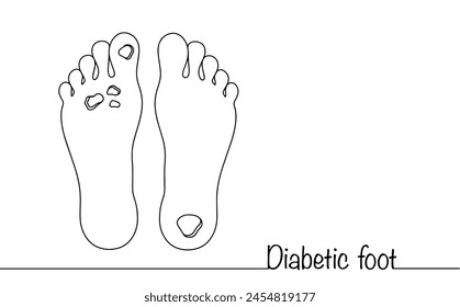 Diabetic foot. Severe complication of diabetes mellitus. ulcerative necrotic lesion of human feet. Medical illustration to educate people about the problem of diabetes.